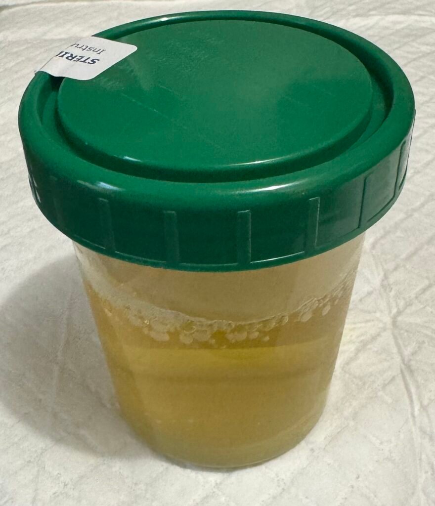 A urine cup filled with fresh urine is the specimen of choice for urinalysis testing.