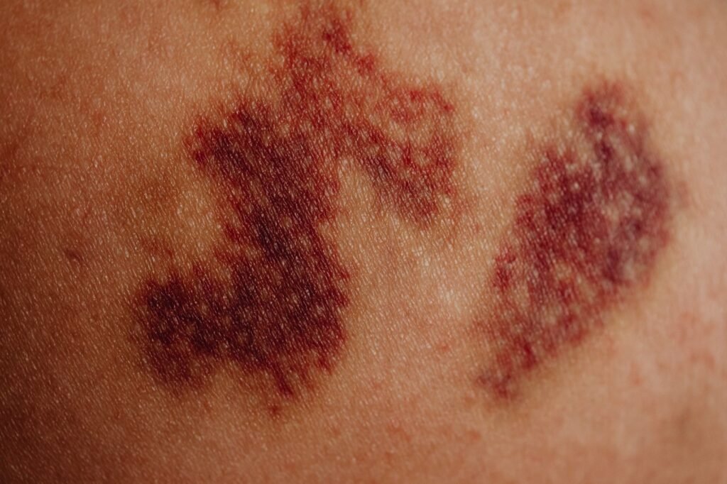Detailed Close Up Of A Bruise On Skin Showing Purplish Discoloration And Texture.