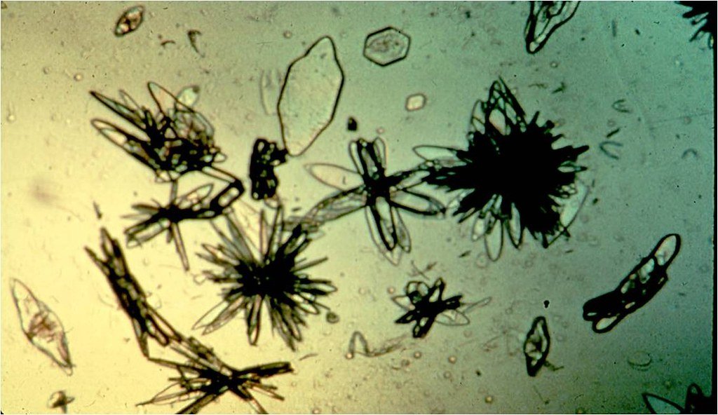 Vvv Uric Acid Rosette